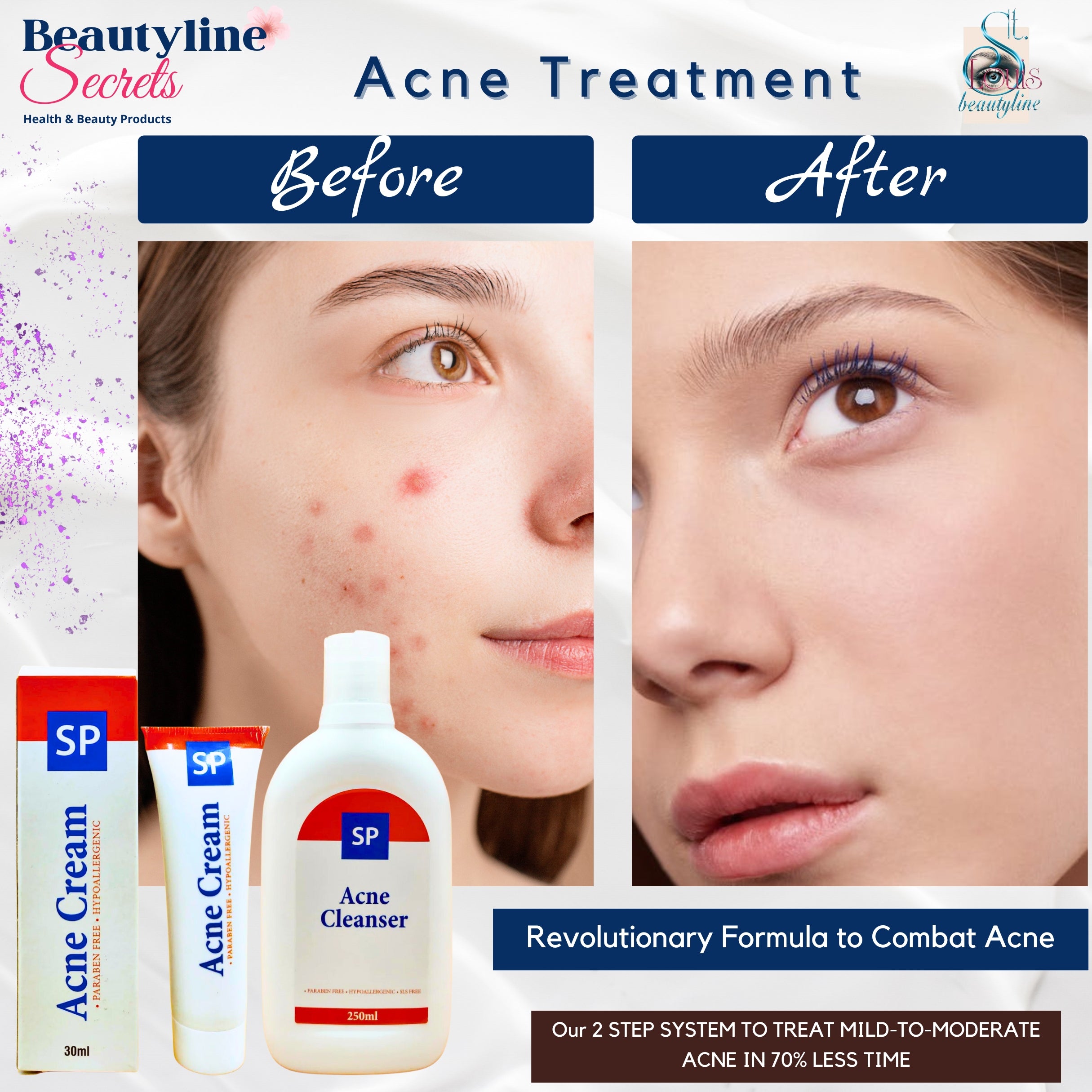 Acne Treatment